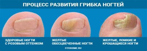 Белизна от грибка ногтей: лечение, отзывы, рецепты
