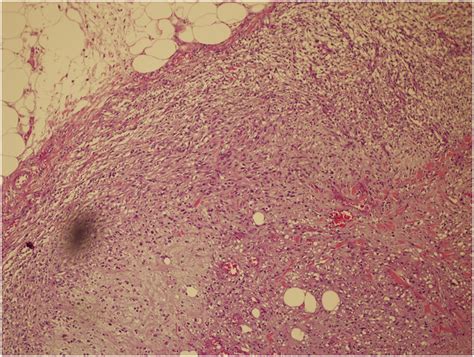 lymph node metastasis  scientific diagram