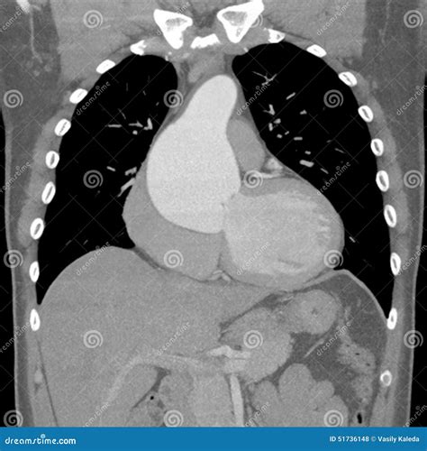 Ascending Aortic Aneurysm on CT Scans Stock Photo - Image of blood
