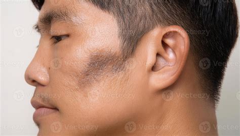 close-up of melasma on cheekbone with gray-brown patch, skin