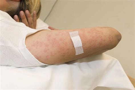 Pemphigoid gestationis | BMJ Case Reports