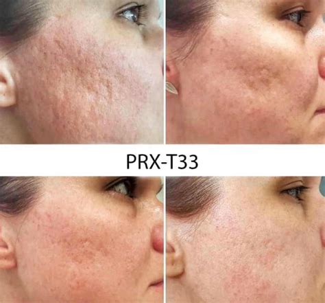 Пилинг PRX-T33: особенности и преимущества процедуры