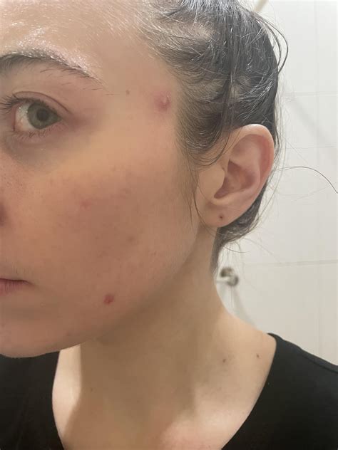 Rosacea nodules? Newish symptom for me and don’t know why : r/Rosacea