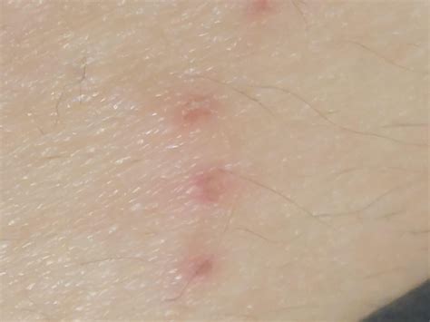 Scabies or post-scabies? : r/scabies