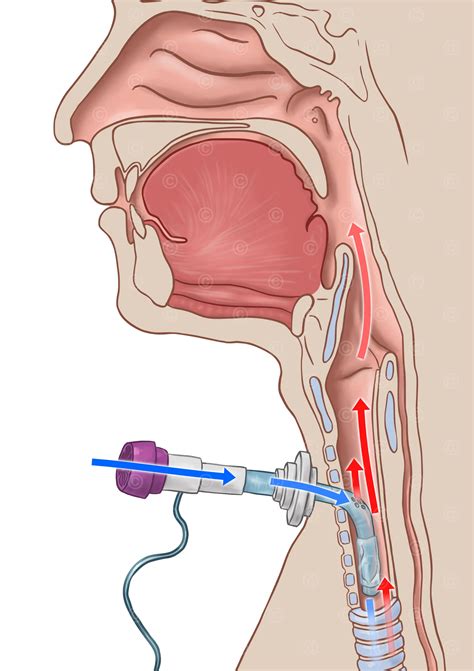 Illustrations tracheostomy management - MedicalGraphics