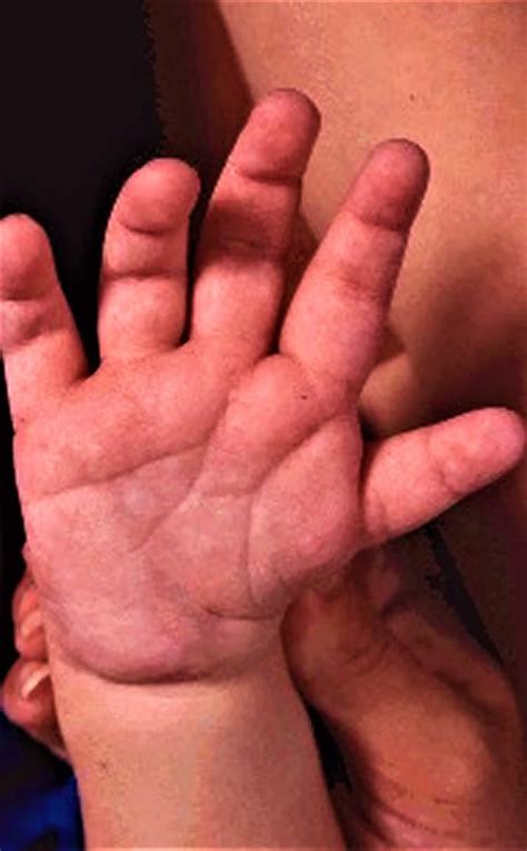 CHARGE syndrome causes, symptoms, diagnosis, life expectancy & treatment