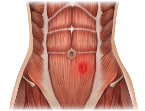 2939 / BILATERAL HERNIA TRUSS – OTCBrace