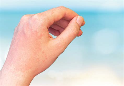 alergia ao sol sintomas  prevencao farmacias mais saude