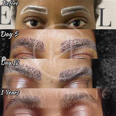 eyebrow transplant    result  year result eyebrow