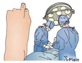 toe amputation