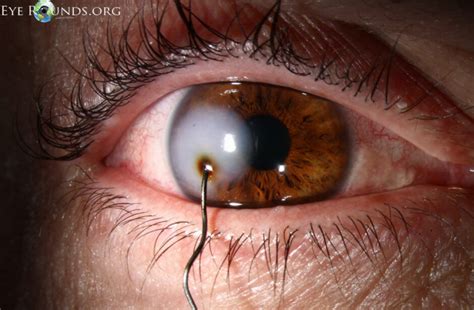 painful red eye  ophthalmology geeky medics