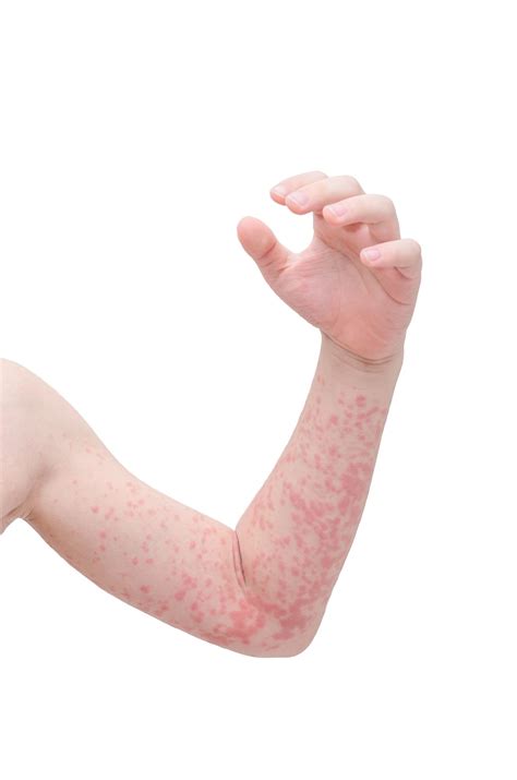 Zithromax Skin Rash in Kids May Be Life-Threatening