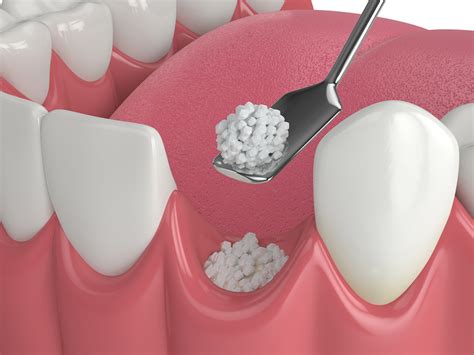 dental bone grafting goliad tx goliad dental care