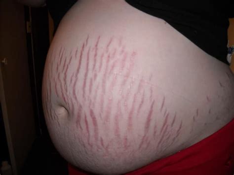 Как выглядит растяжки при беременности фото – 7 шт. | Stretch marks ...