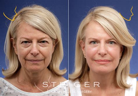 face lift cheeks 7