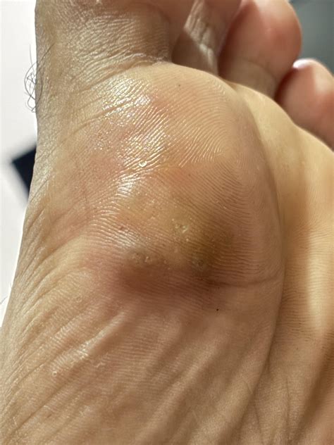 Are these warts? : r/Warts