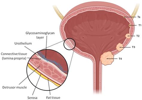 Best Medicine For Bladder Cancer at Michael Oglesby blog