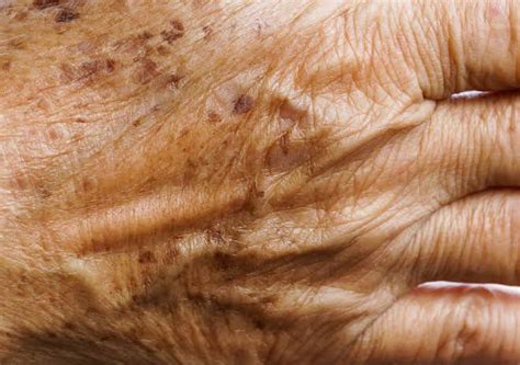 Mancha Na Mão Escura - Por que temos manchas escuras no dorso das mãos? | Dermatolaser