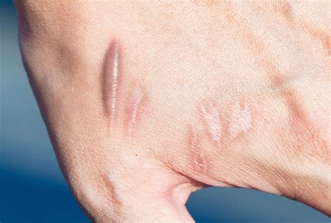 scar keloid circumcision  cynthia brandenburg blog
