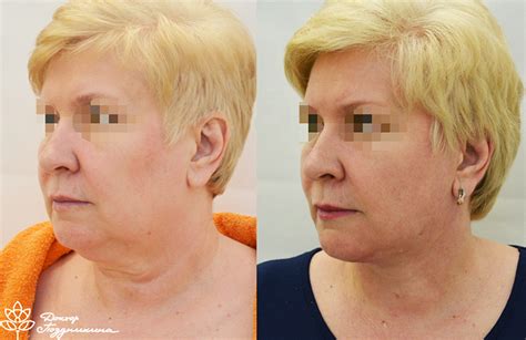 Липосакция подбородка, отзывы * реабилитация, фото до и после лазерной ...