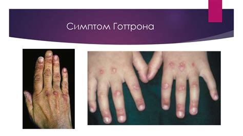 Дерматомиозит - презентация онлайн