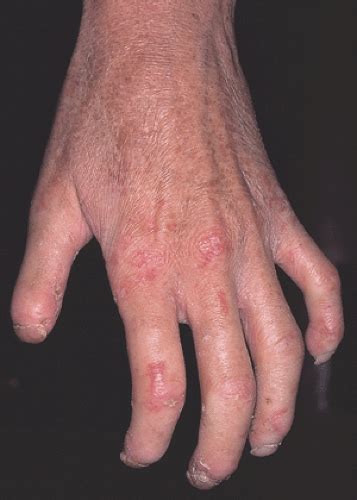 Scleroderma (Progressive Systemic Sclerosis) | Plastic Surgery Key