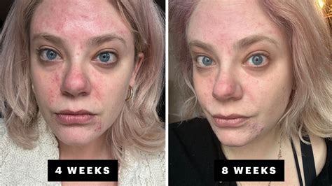 Souirensu It Works: My Before & After Photos Will SHOCK You! - 1y2hf45