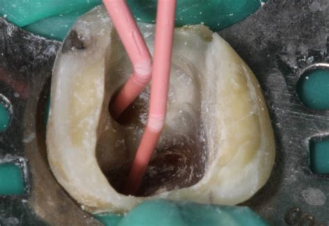 endodontic retreatment  root perforation  mta repair cement
