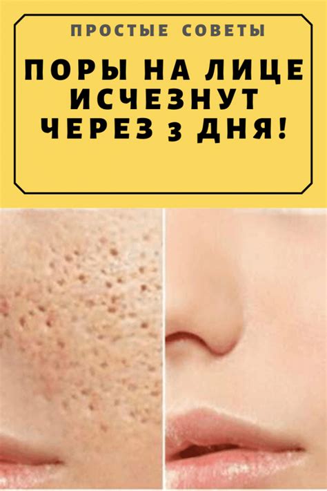 Поры на лице исчезнут через 3 дня! — Простые советы Acne Skin, Skin ...