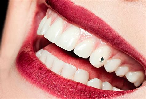 Стразы на зубах | DENTAL-INFO