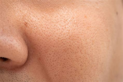 Pores dilatés - Médecine esthétique et vasculaire - Dr Gandillet
