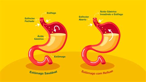 Queimação No Estomago O Que Comer