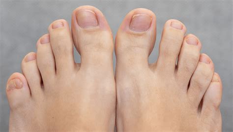 pinky toe  top  foot outlet emergencydentistrycom
