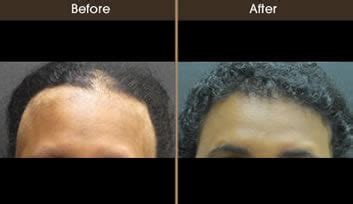 Vitiligo Hair Loss