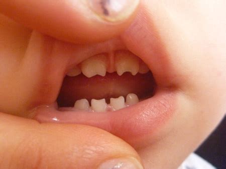 Зубы Гетчинсона, Фурнье, Пфлюгера – аномалии формы зубов