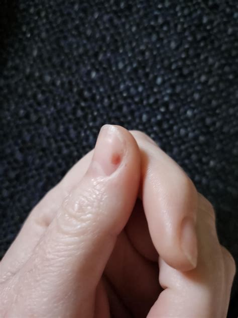 Bruised nail : r/RedditLaqueristas