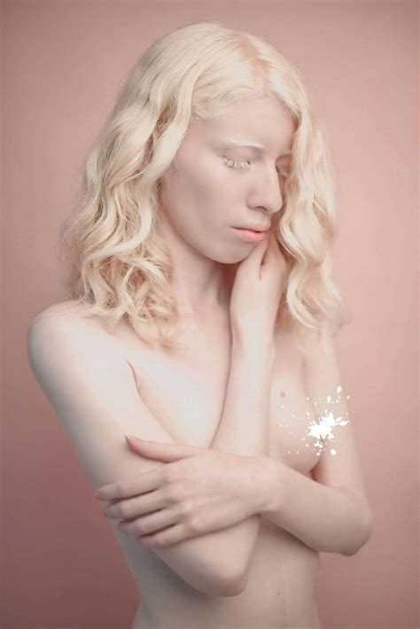 Albino Model Says 'Being Different is a Blessing'
