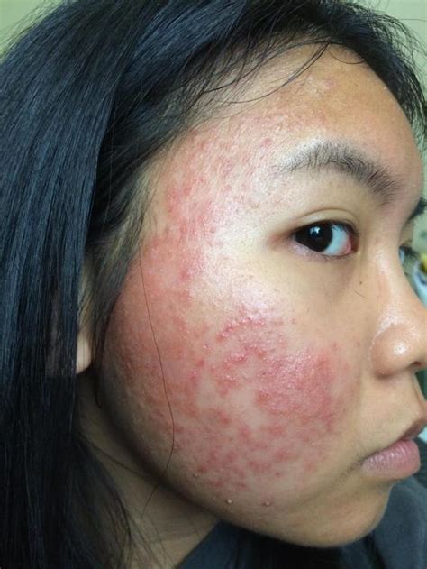 Allergic Reaction Rash On Face Cream at Robert Keck blog