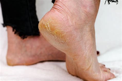 How to Remove Thick Dead Skin from Feet Without Pumice Stone: A