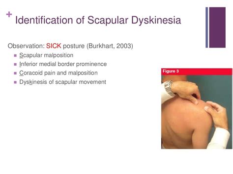 Scapular dyskinesia and its relationship to rotator cuff impingement