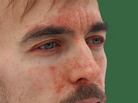 Is Perioral Dermatitis Contagious? – Balmonds