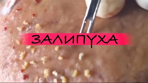 ЗАЛИПУХА ПРЫЩИ ВЫДАВЛИВАНИЕ - YouTube