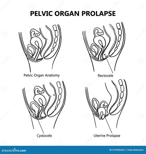 Pelvic Organ Prolapse