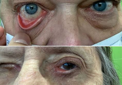 ectropion repair minneapolis fixing turned  eyelid st paul