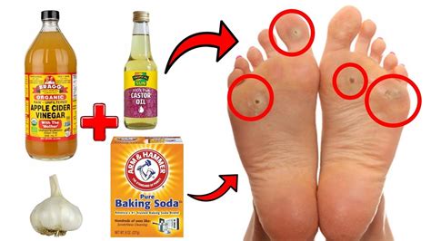 14 Proven Home Remedies For Corns & Callus Removal THAT WORK! - YouTube