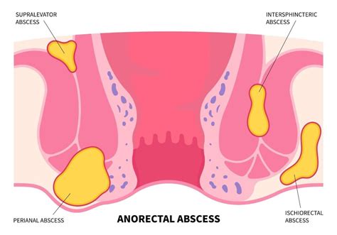 Perianal/ischiorectal abscess - Tan Siong San Surgery | Gallbladder