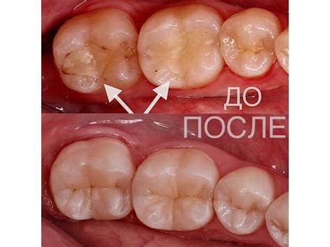 Глубокий кариес под пломбой: случай успешного лечения под контролем ...