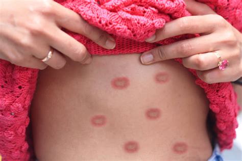 60+ Smallpox Pustules Stock Photos, Pictures & Royalty-Free Images - iStock