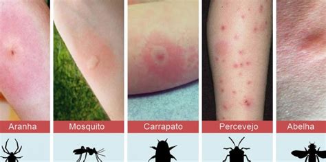 Picada De Carrapato Infeccionada - Essas são as 8 picadas mais comuns de insetos que você precisa conhecer ...
