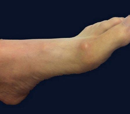 foot ganglion cyst risks ultrasound guided aspiration  ganglion